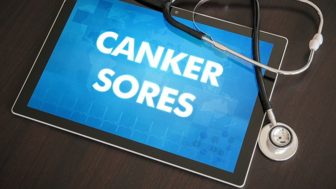 Essential Oils for Canker Sores Images